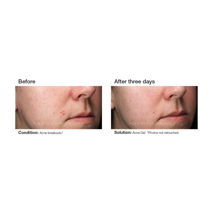 PCA SKIN Acne Gel